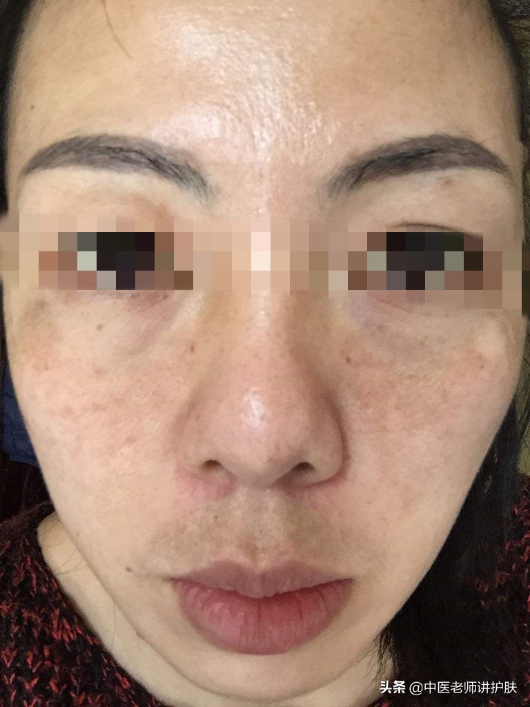 色斑也得分类别,从中医角度浅谈色斑成因,这样治疗更有效