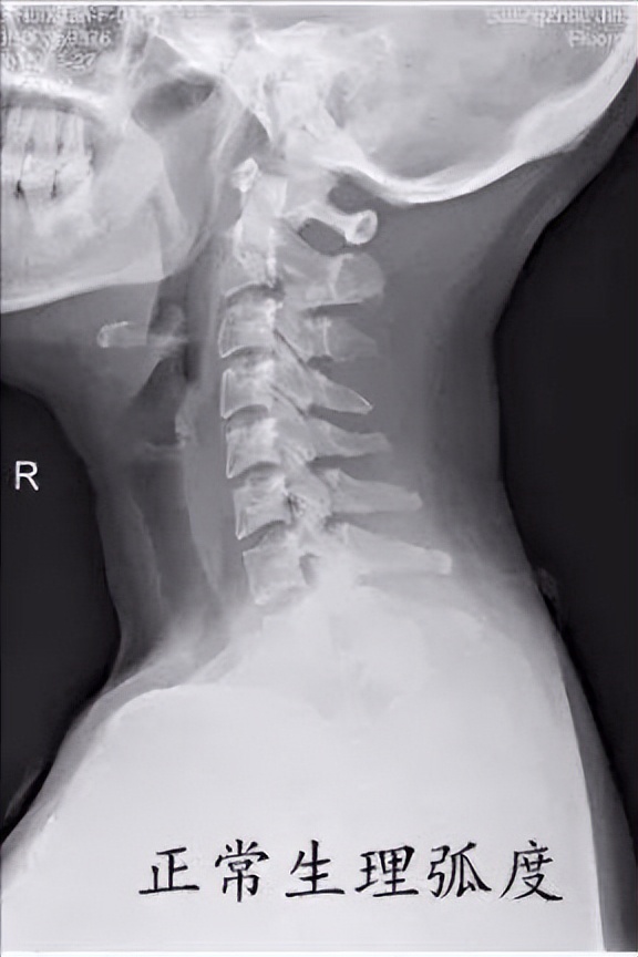 颈椎病生理弯曲的最好治疗方法,颈椎生理性弯曲消失是怎么回事