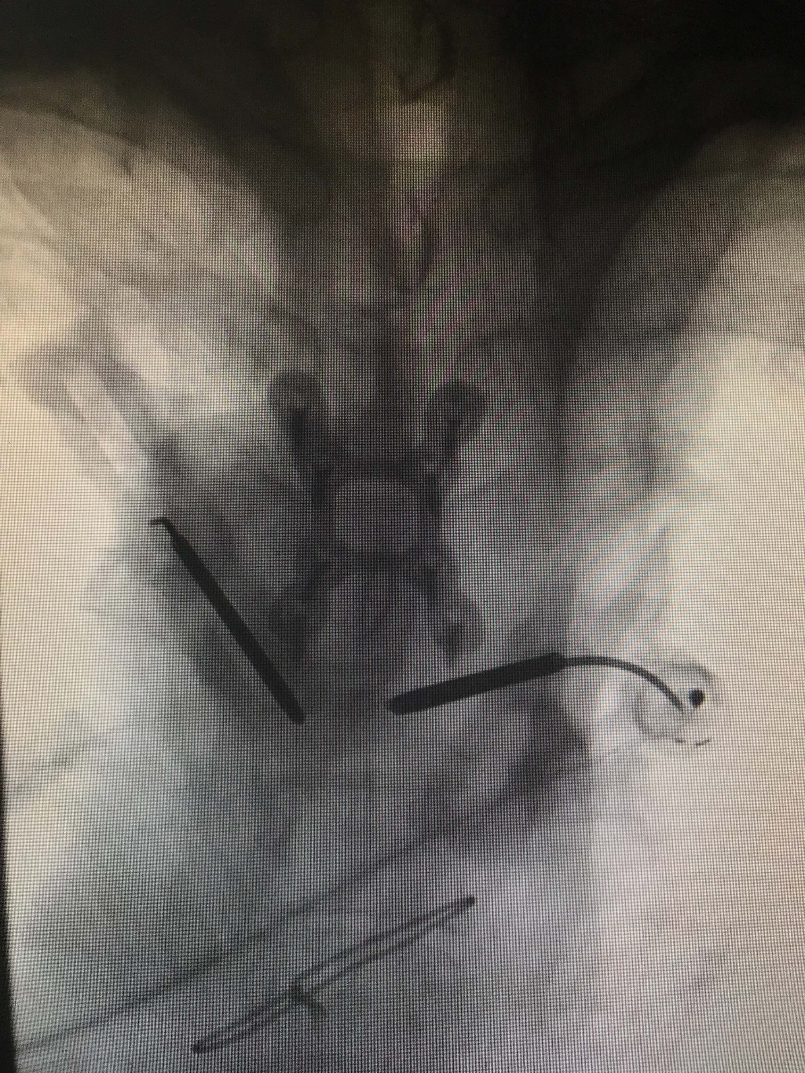 胸椎压缩性骨折微创手术利弊,胸椎压缩性骨折保守治疗20例
