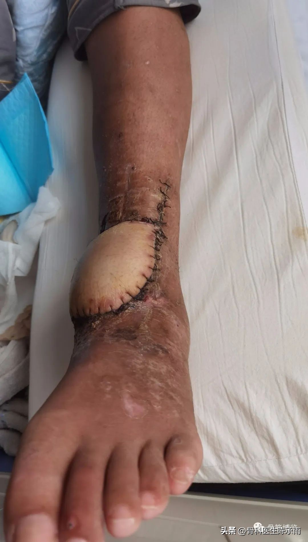 娓哥鐨摚淇,涔旀皬鐨摚淇瓒宠儗澶栦晶鐨偆缂烘崯