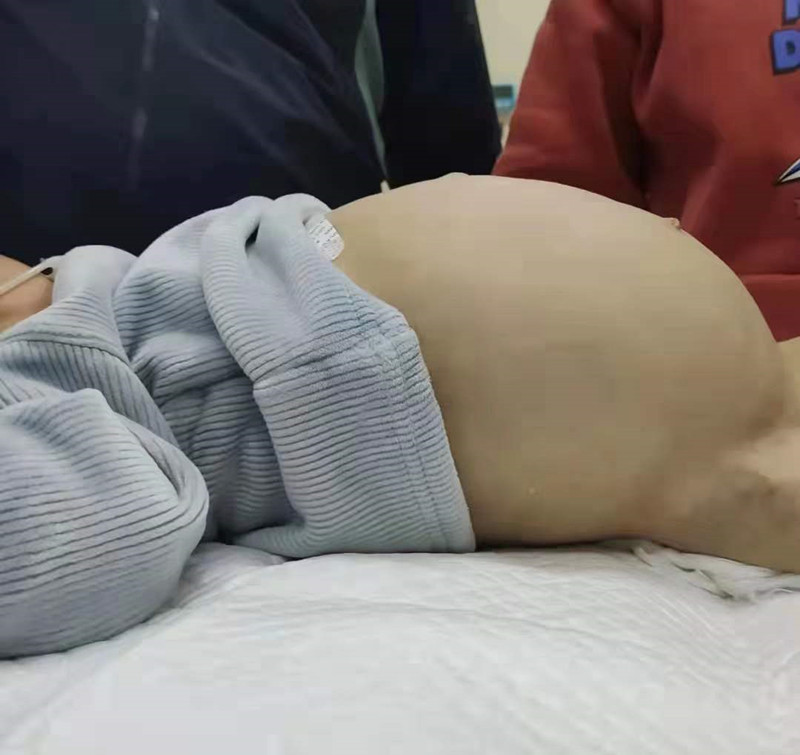 男孩腹胀如鼓,患儿男1岁腹痛哭闹呕吐