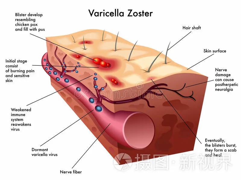 专家提醒这些症状是疾病的征兆,这种疼起来要命的病该怎样避免