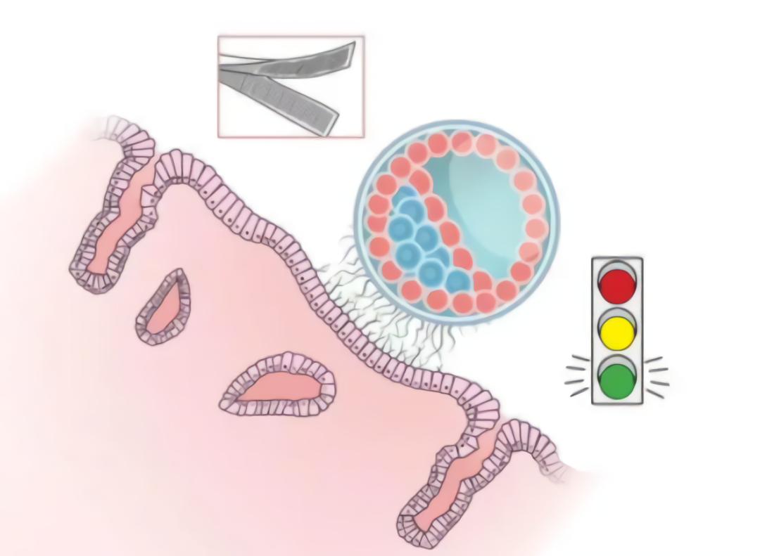 导致子宫内膜异位症患者不孕,造成不孕不育的隐形杀手
