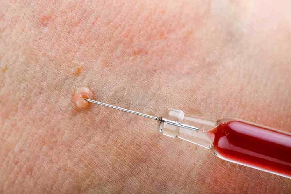 皮肤长出一个小疙瘩是什么,皮肤上长的小肉球可以自己处理吗