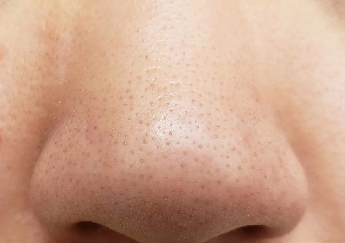 鼻子黑头里挤出的白色油脂怎么办,鼻子上有硬硬的黑头怎么办