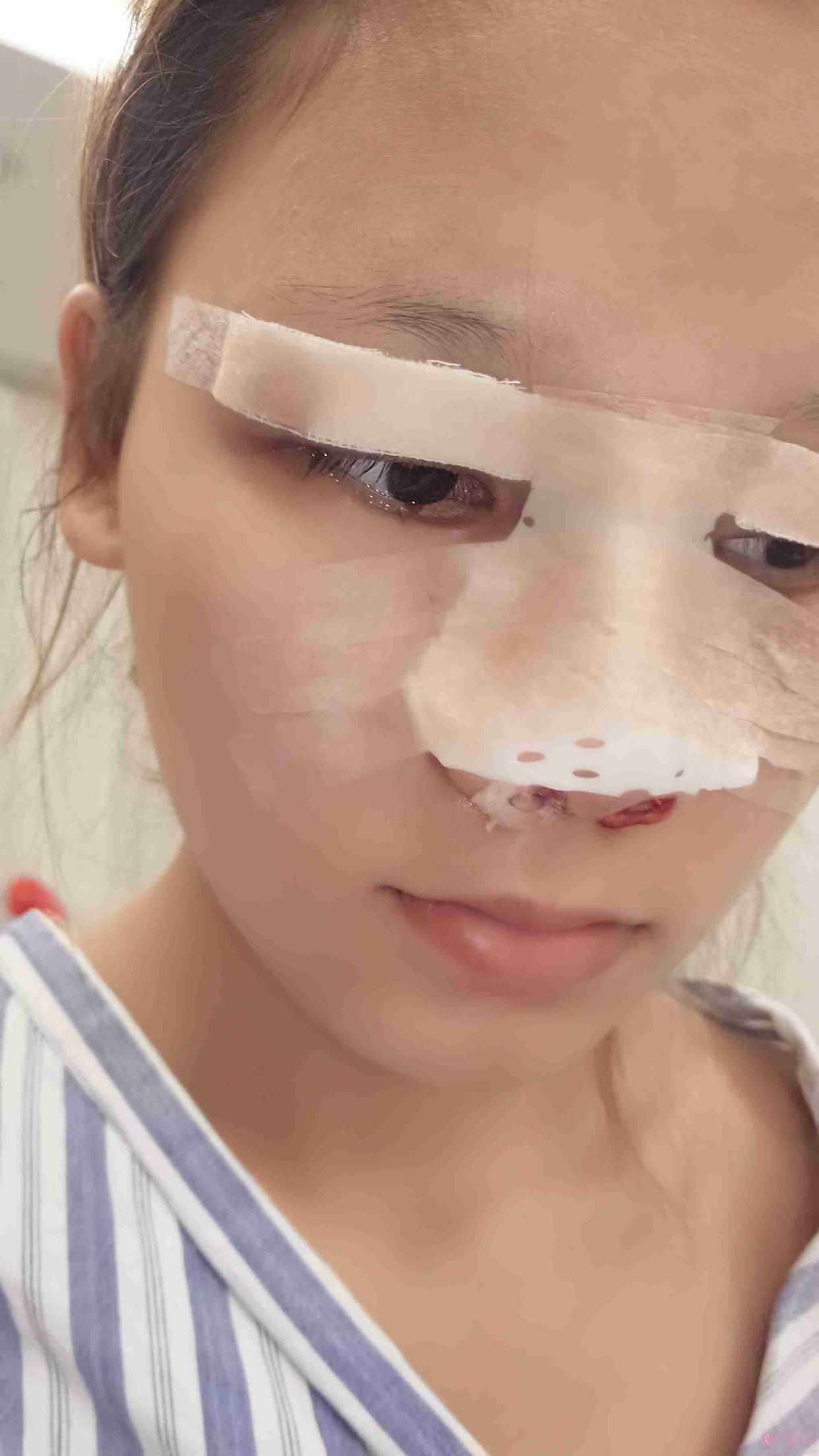 整容朝天鼻案例,朝天鼻整容成功案例