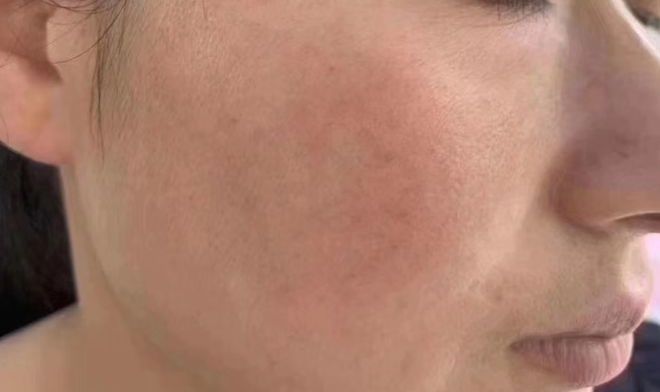 脸上皮肤暗黄多斑教你一个新招,脸上斑越来越多是褐斑应该怎么办