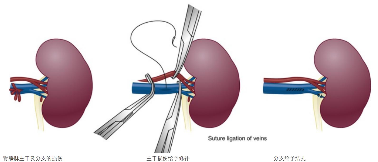 钝性闭合性肾损伤的诊治策略
