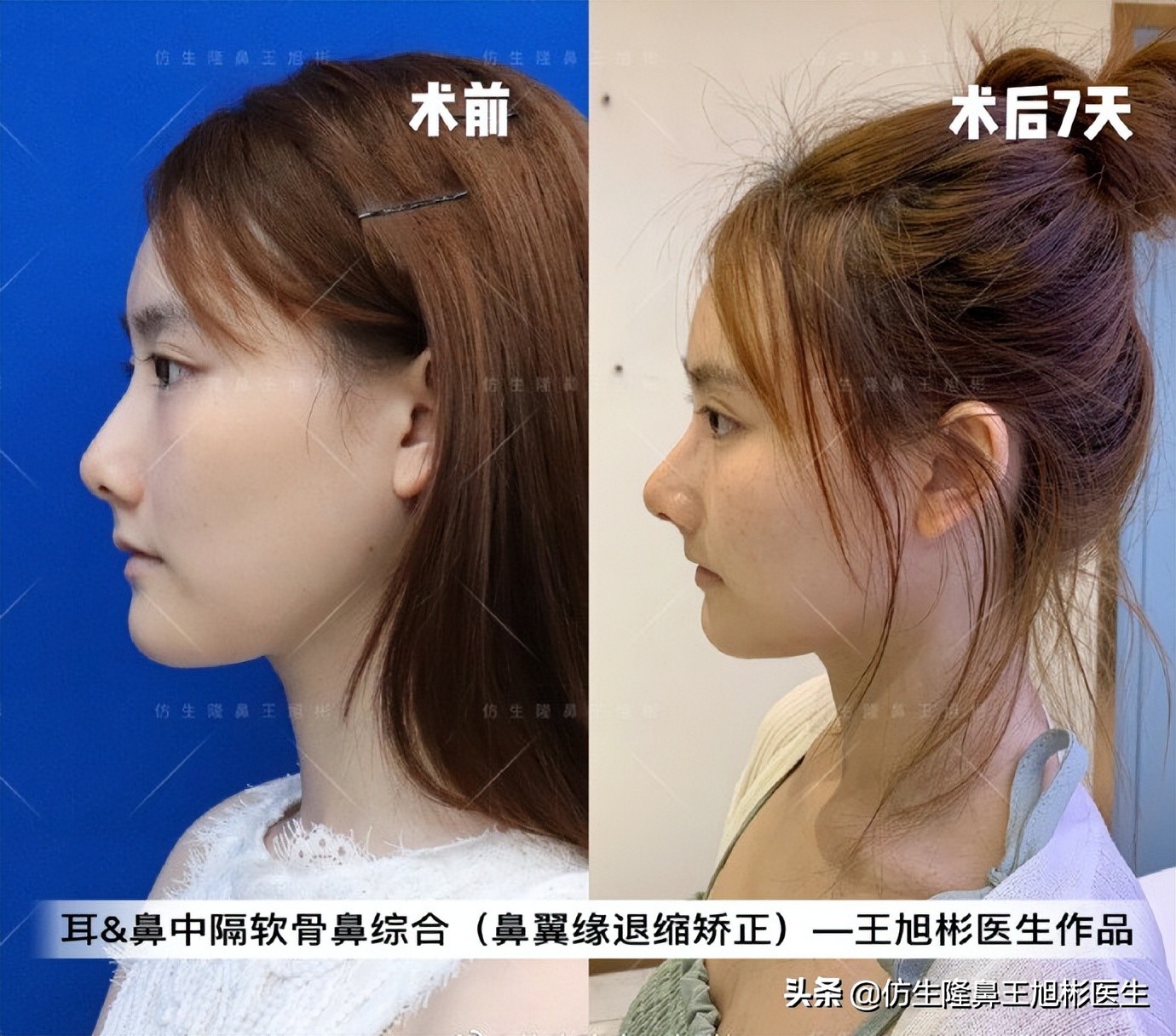 王旭彬：朝天鼻、露鼻孔，模特菲菲短鼻矫正手术后1.5个月