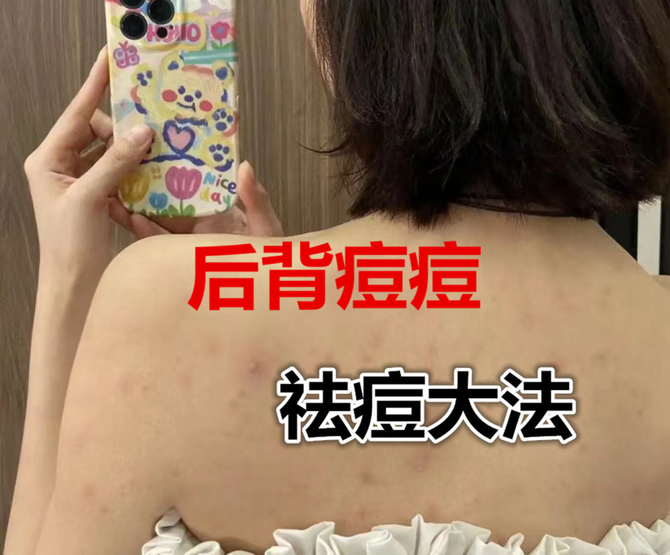 消除脓包痘痘最快的土方,9个有效祛痘小妙招简单有效