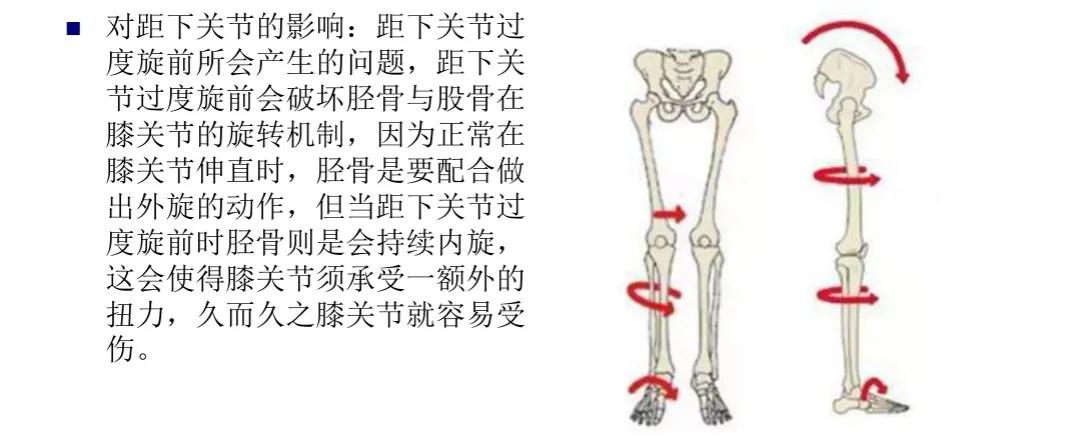 扁平足发病机制,扁平足诊断标准示意图