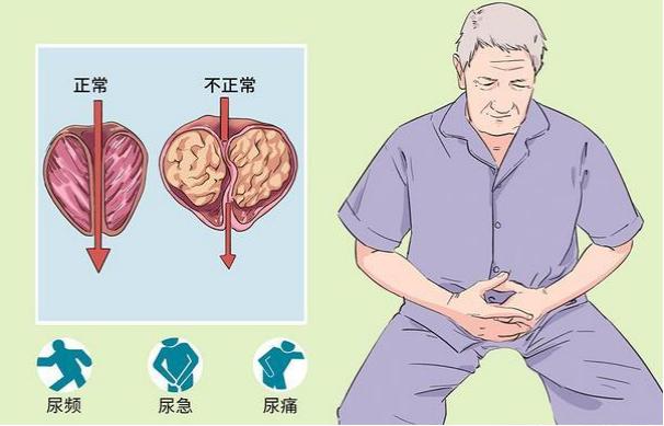 平常吃什么药可以保护前列腺,想彻底治好前列腺炎