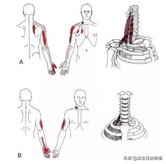 左侧后背肩胛骨内侧缘隐痛,后背肩胛骨部位痛是有炎症吗