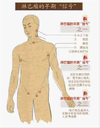 医考临床基础知识,胃恶性淋巴瘤存活期