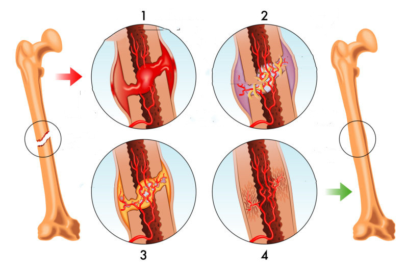 骨折后吸烟影响愈合么,吸烟对骨折愈合有多大影响
