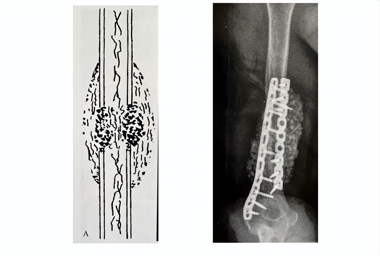 治疗骨折新技术,微创手术治疗骨折的方法