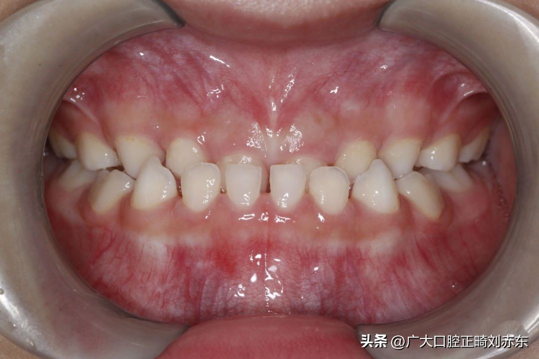 反颌属于什么病,牙反颌是什么原因