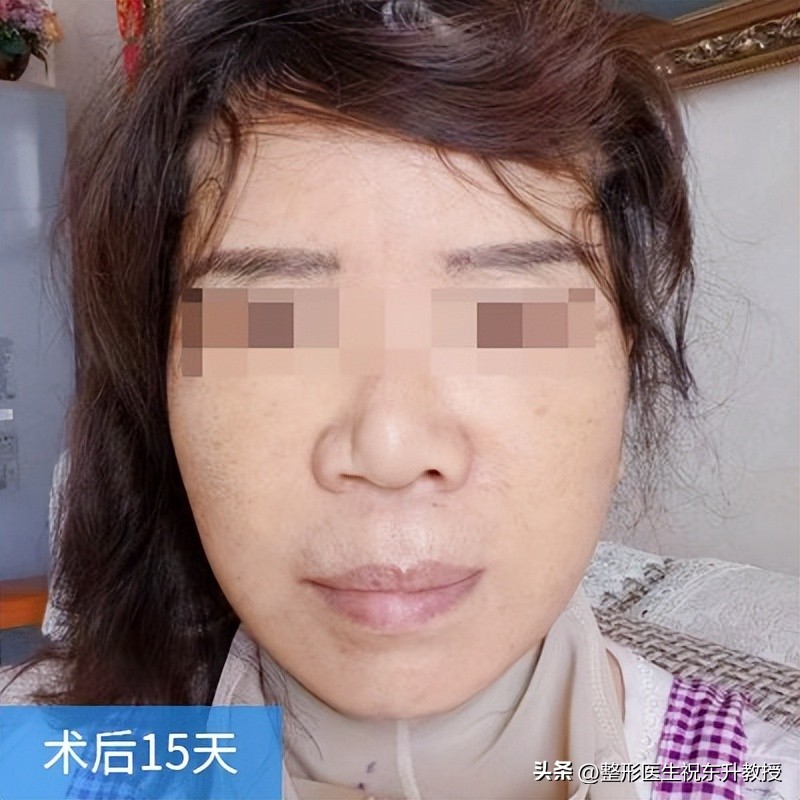 全脸拉皮手术前后的真实对比,脸部拉皮手术恢复过程图