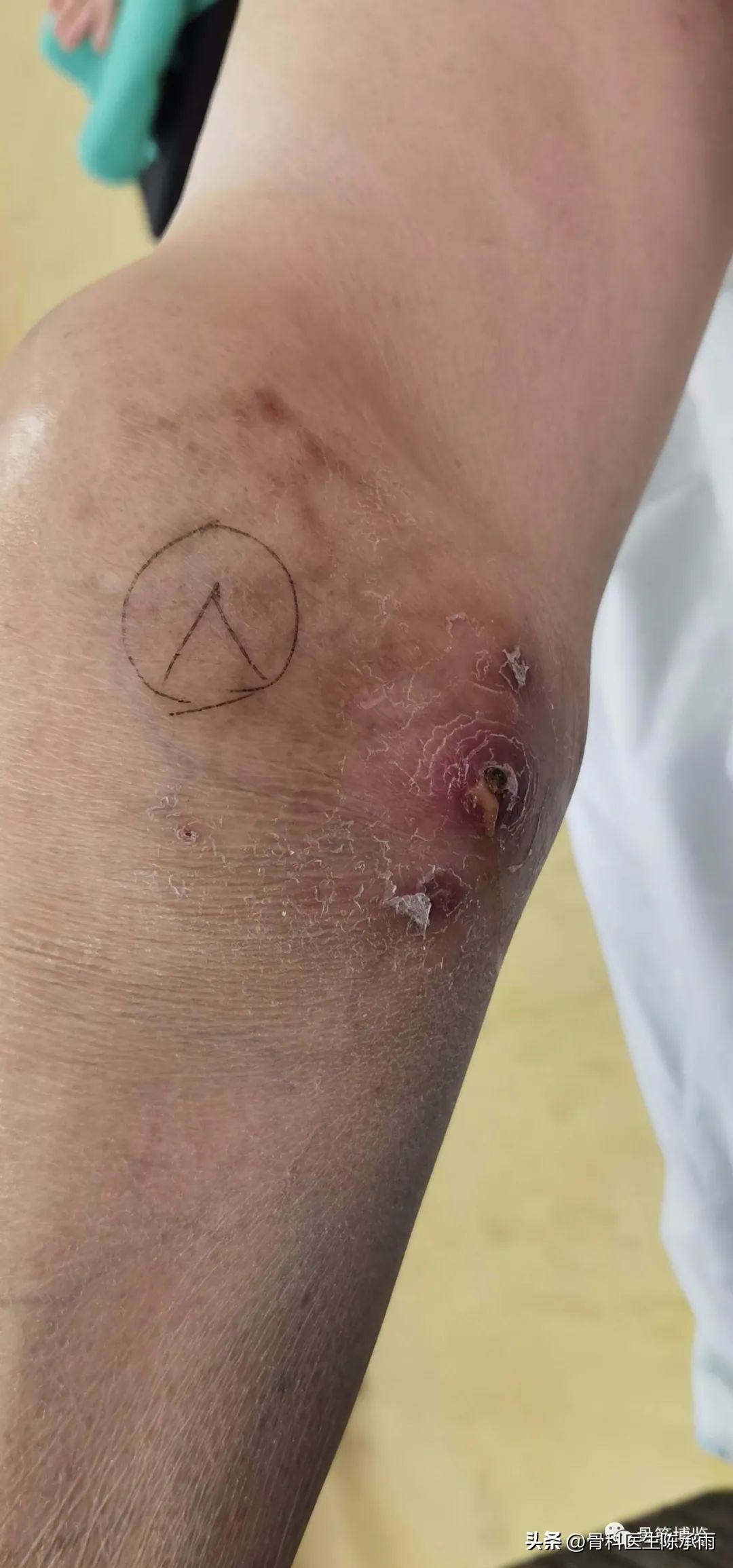 化脓性关节炎的穿刺引流治疗,关节炎镜下治疗