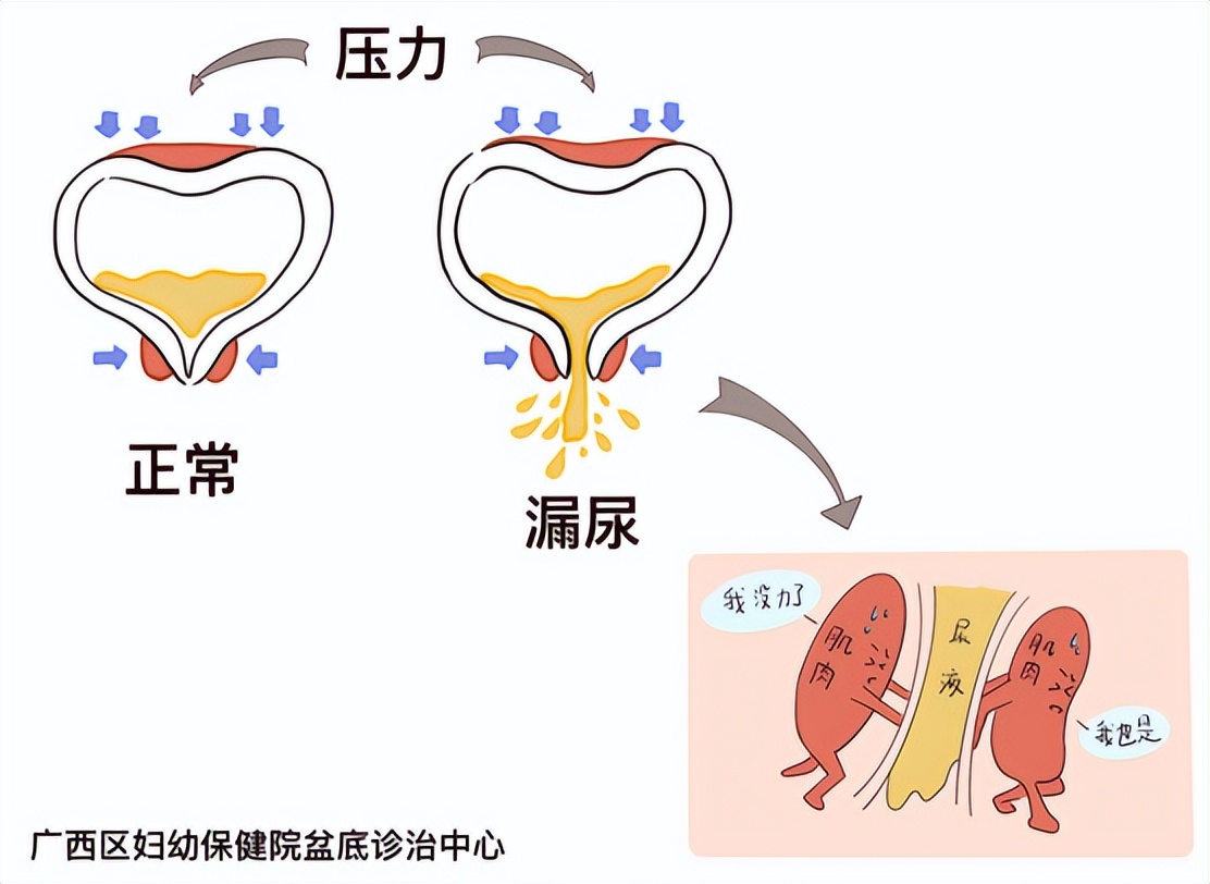 科普丨经常漏尿？解除尴尬其实很简单