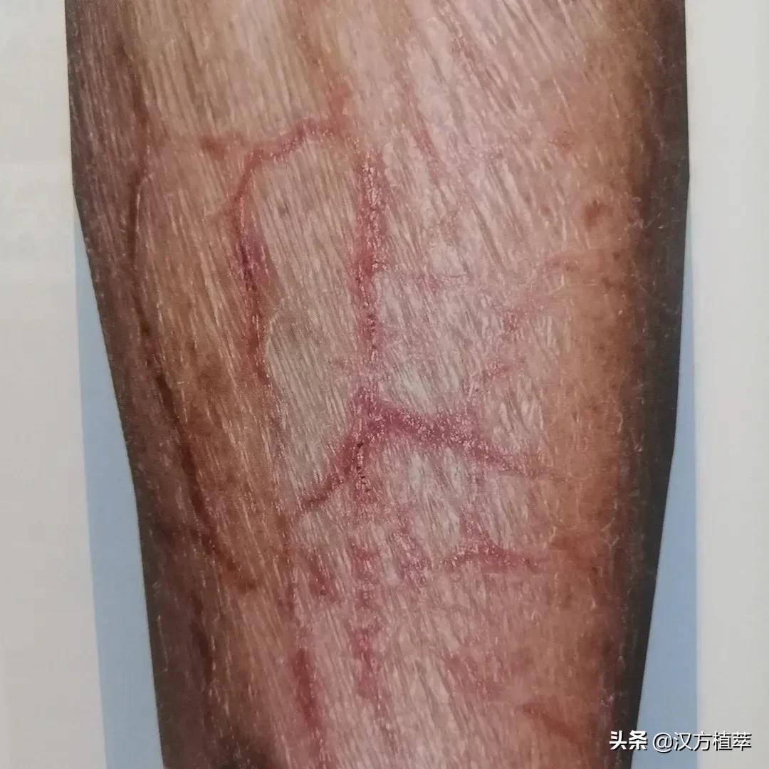 啥？湿疹还有干性的？