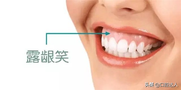 打骨钉改善露龈笑多久能看到效果,露龈笑是天生的吗