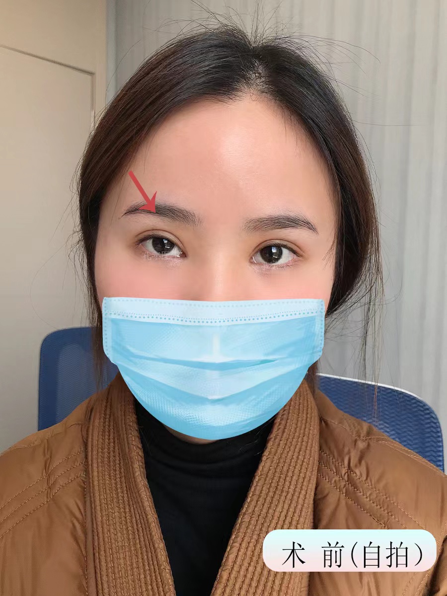 做了双眼皮后上睑下垂更严重了,双眼皮宽变窄修复后成了三眼皮