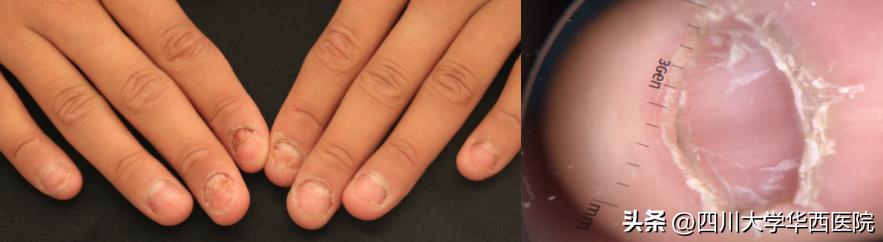 华西专家说，不是转你们，起码有一半的人从没有剪对过指甲儿！