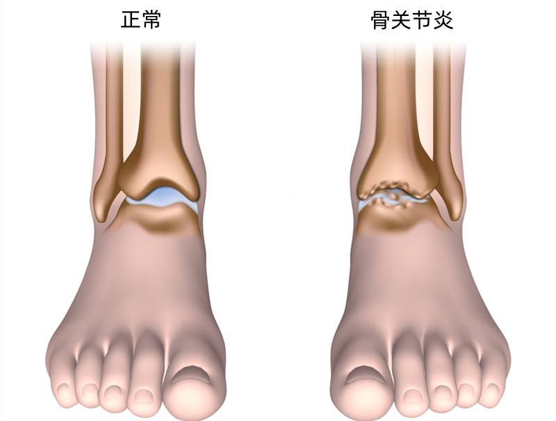 脚踝走路咯咯响怎么回事,走路脚踝发出清脆响声还容易抽筋