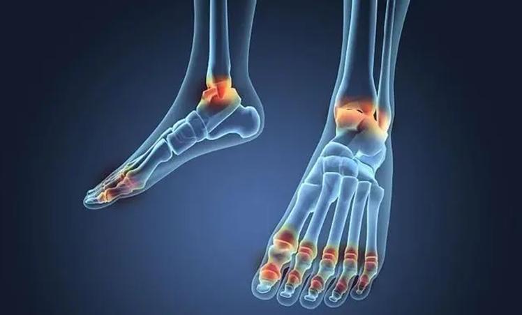 什么是痛风痛风都有哪些表现,什么是痛风痛风的主要症状是什么