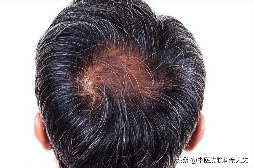 两鬓和后脑出现白发是什么原因,前额两鬓白发的原因及解决方法