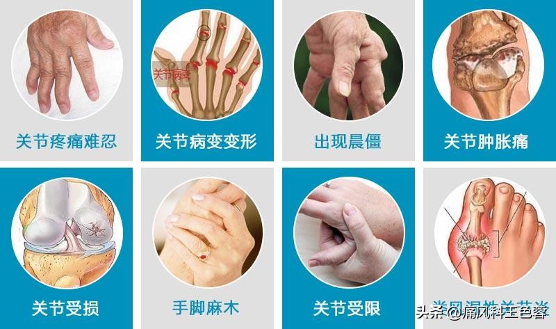 抗类风湿药有哪些首选,抗风湿类风湿有哪些药