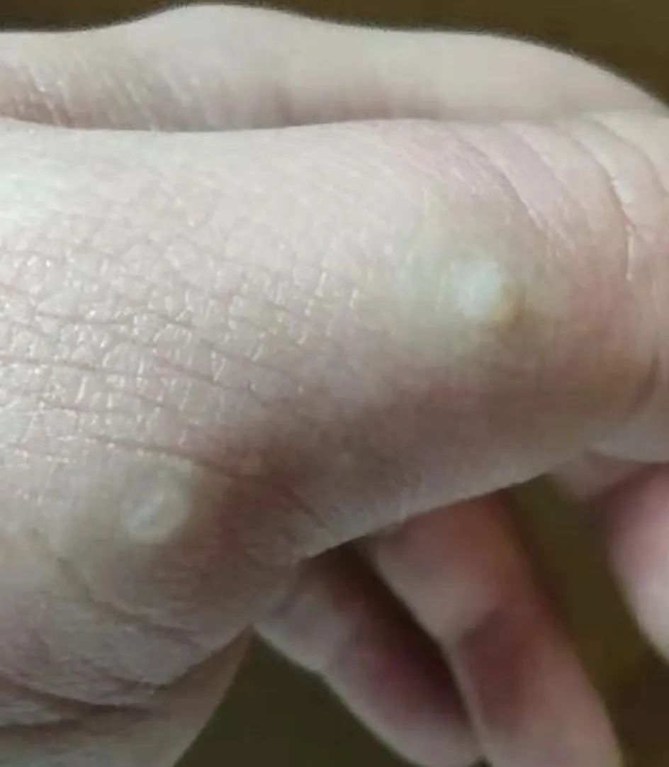 皮肤上的寻常疣可以不治疗吗,皮肤疣不治疗会怎么样