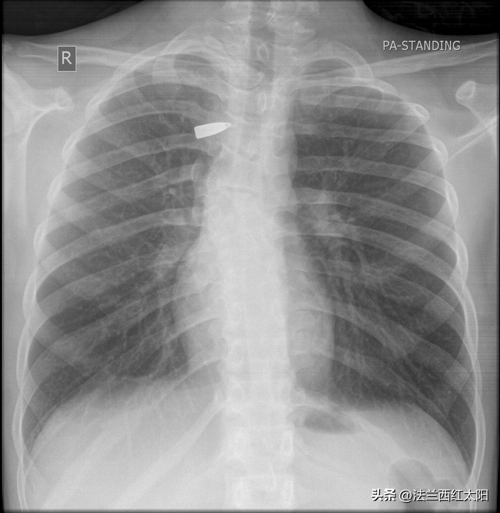 弹头留在体内会怎样,弹头留在体内会变形么