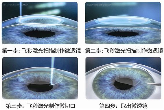 全飞秒眼睛手术需要注意什么,全飞秒手术两个眼睛全过程