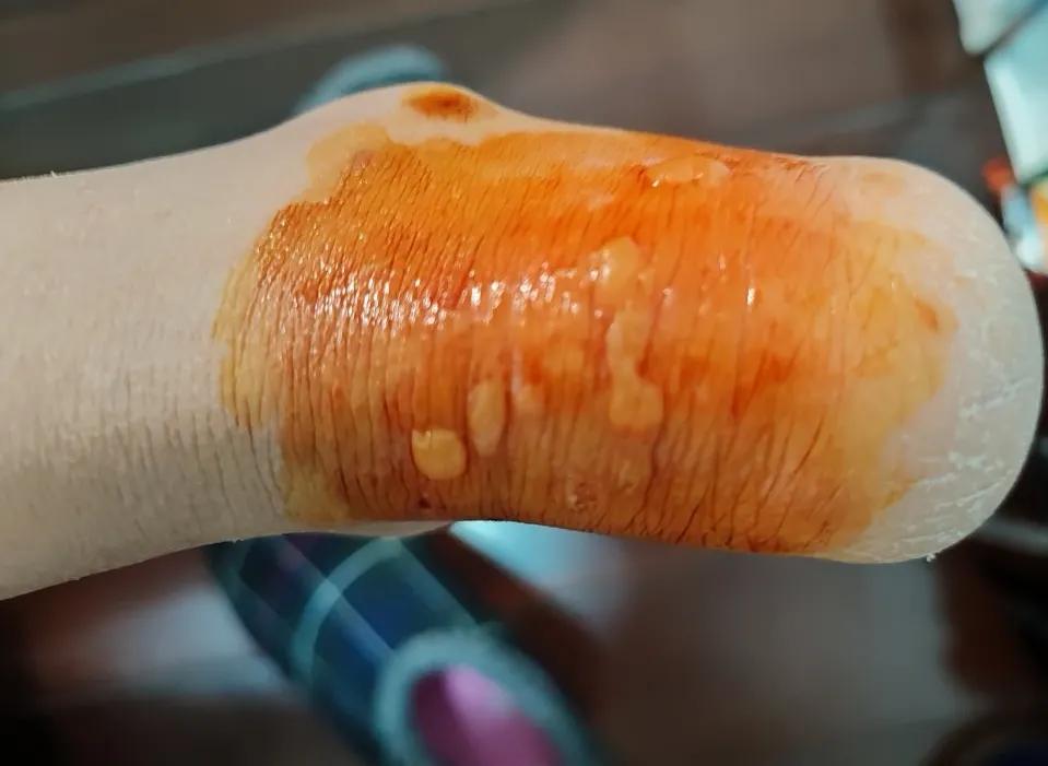 脚后跟红肿皮干,脚后跟红肿用什么药治疗