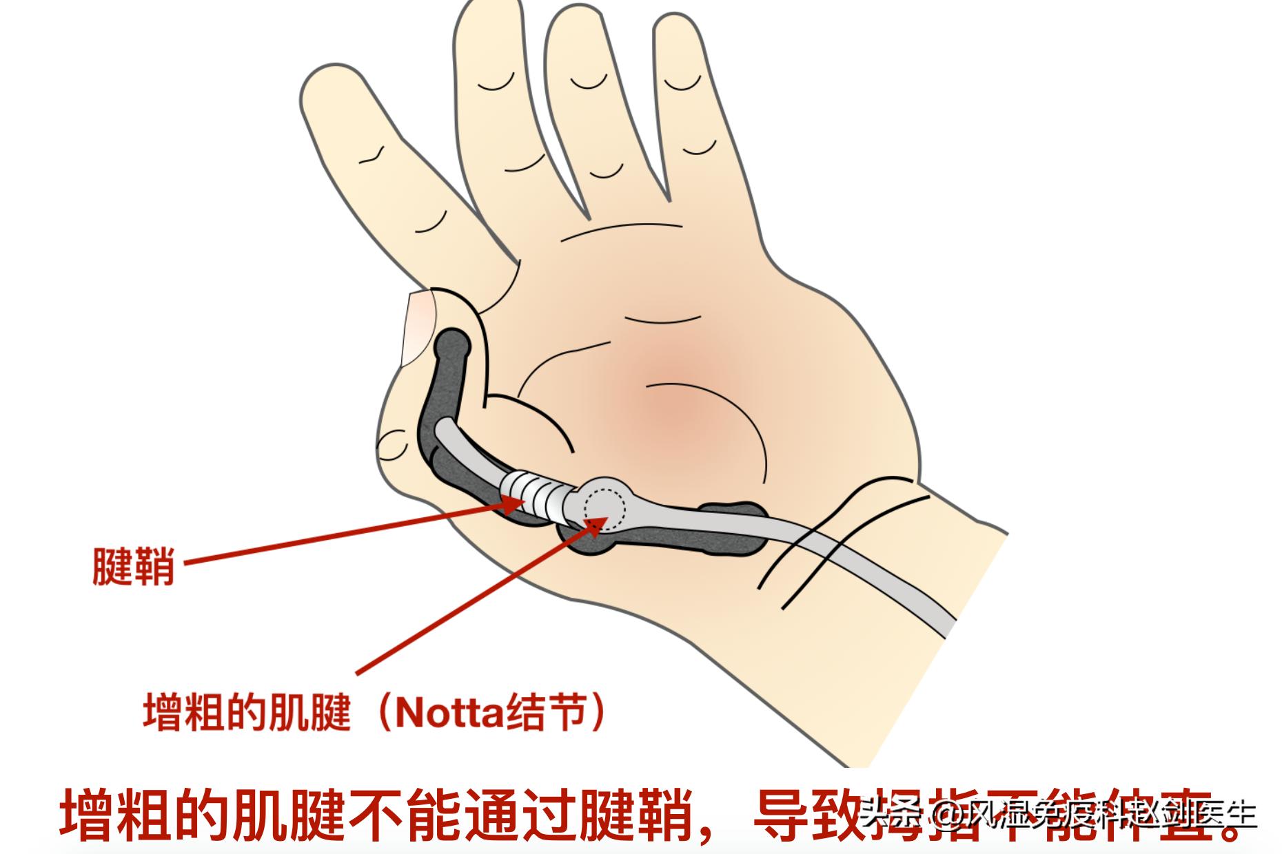 敲键盘手腕酸疼,敲键盘手腕肿痛