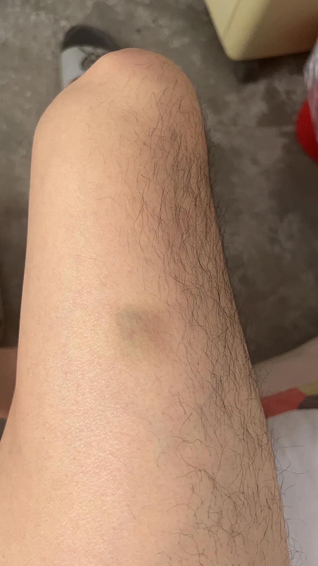 急性白血病的确诊依据,白血病m3的确诊方法