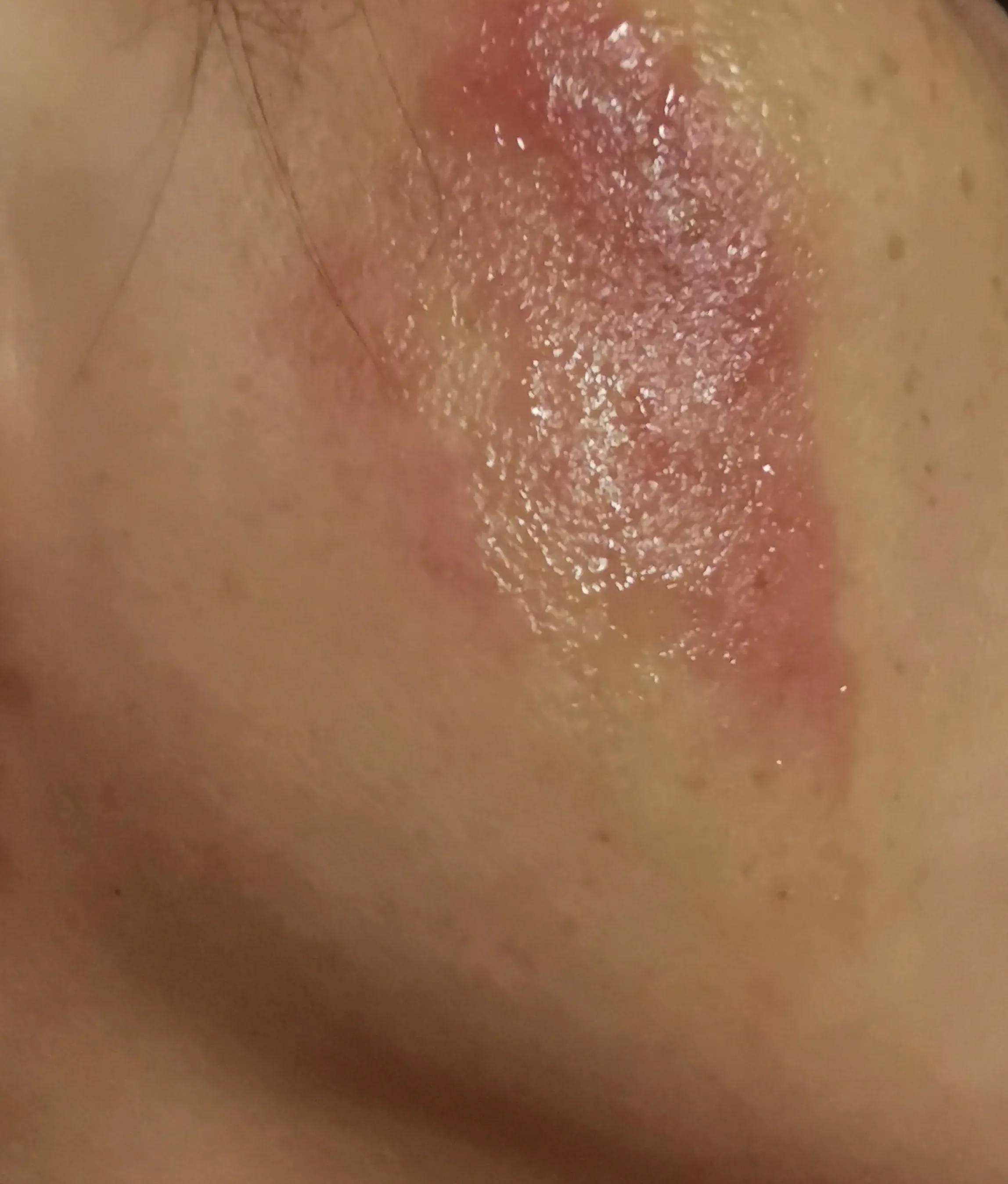 我被隐翅虫咬了（附处理方法）