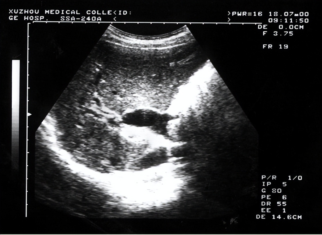 胃穿孔的症状及治疗方法,胃穿孔什么治疗方法好