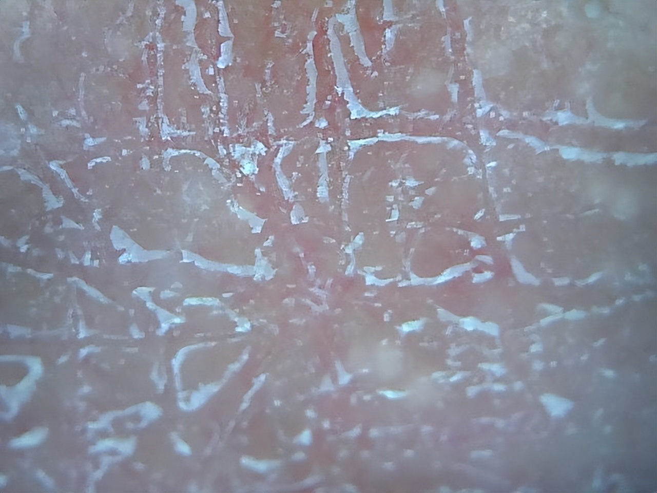 冬季皮肤干燥起皮有纹,皮肤干燥起蛇皮纹