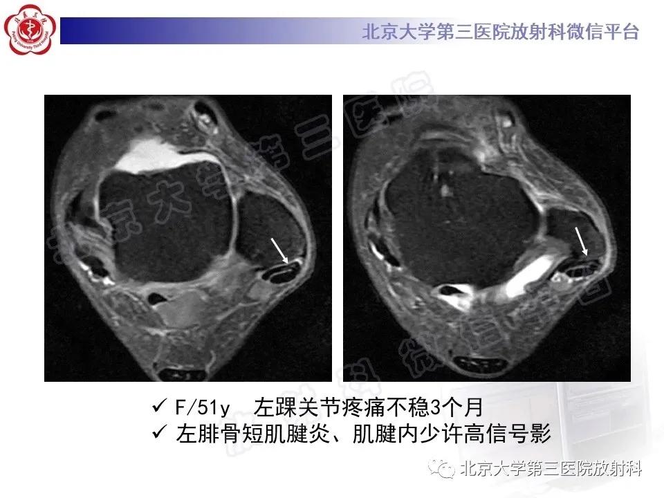 好文分享续集,腓骨肌腱脱位手术价格