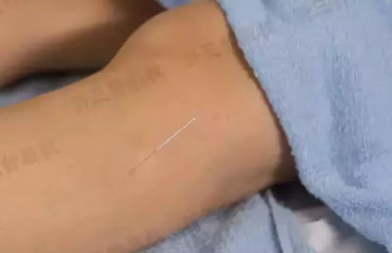 走进中医|运用中医岐黄针对中风后下肢痉挛症状的治疗