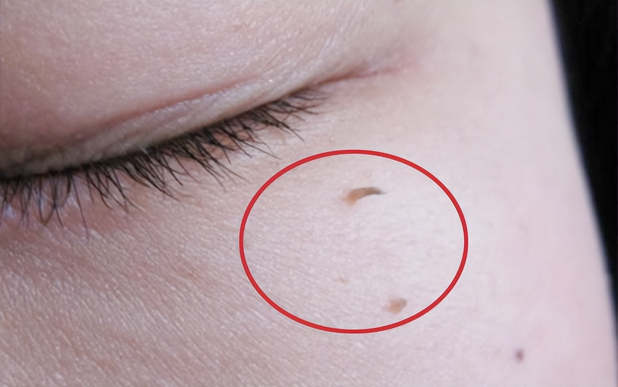 眼睛脖子眼皮有小肉粒是hpv吗,眼睛上的小肉粒是hpv