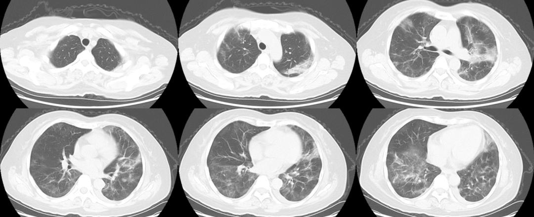 新冠感染第5天病情一直反复,新冠感染后病情历程