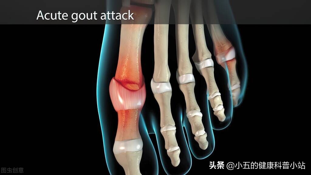 非布司他是防治痛风的常用药,可以长期服用,但需要注意这4点