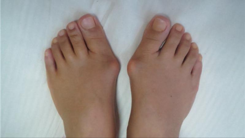 脚底板起茧子走路疼怎么回事,脚底板长茧走路痛咋办