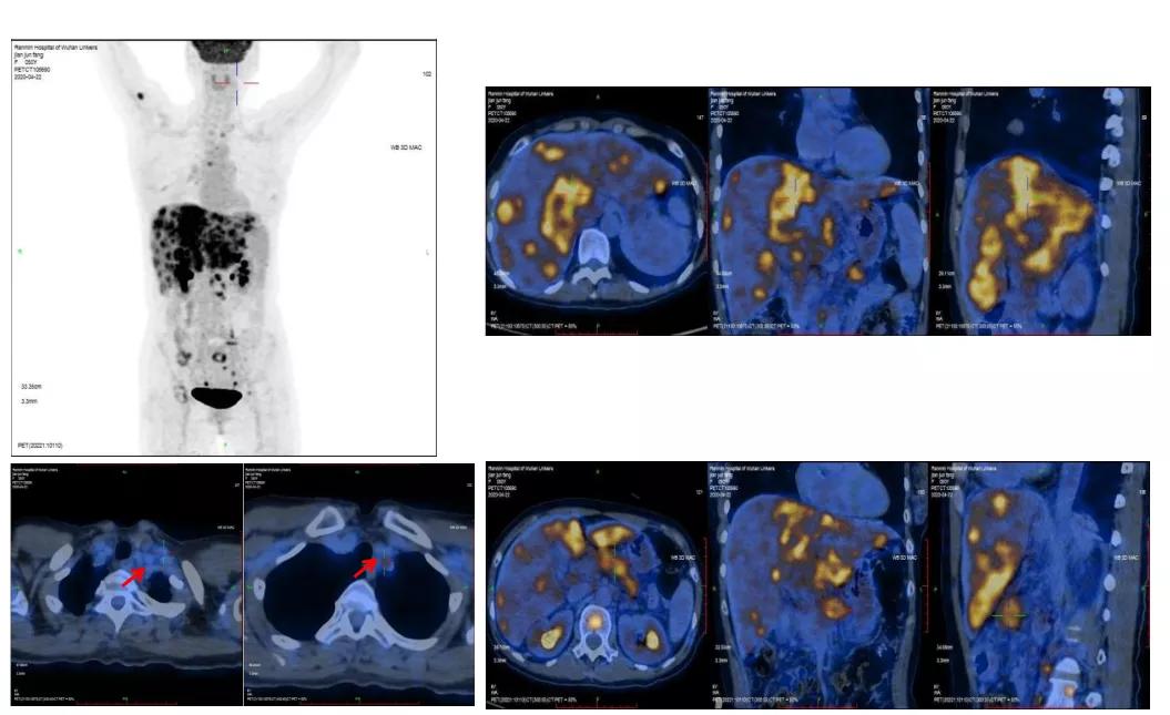 病例实录|免疫联合方案治疗胰腺癌多发转移的病例分享