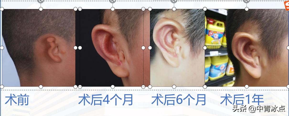 还记得西安疫情中117个脑袋挂着“水球”的小耳症患者吗？主刀医生发微博着急做手术，后来呢？