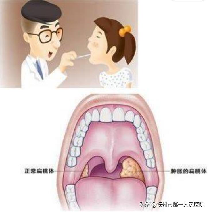 厦门耳鼻喉医院扁桃体切除,耳鼻喉科扁桃体切除术用什么方法